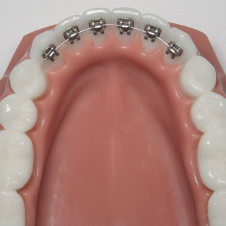 Lingual Braces hidden behind your teeth