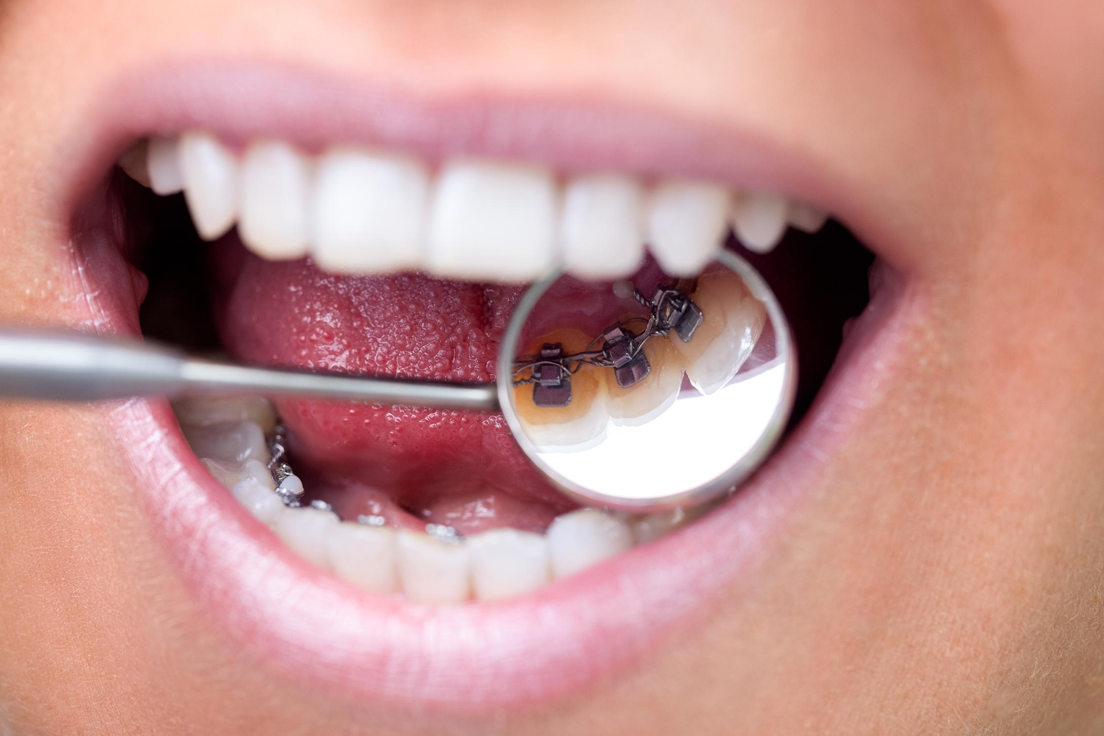 Lingual-Braces Lingual-Braces